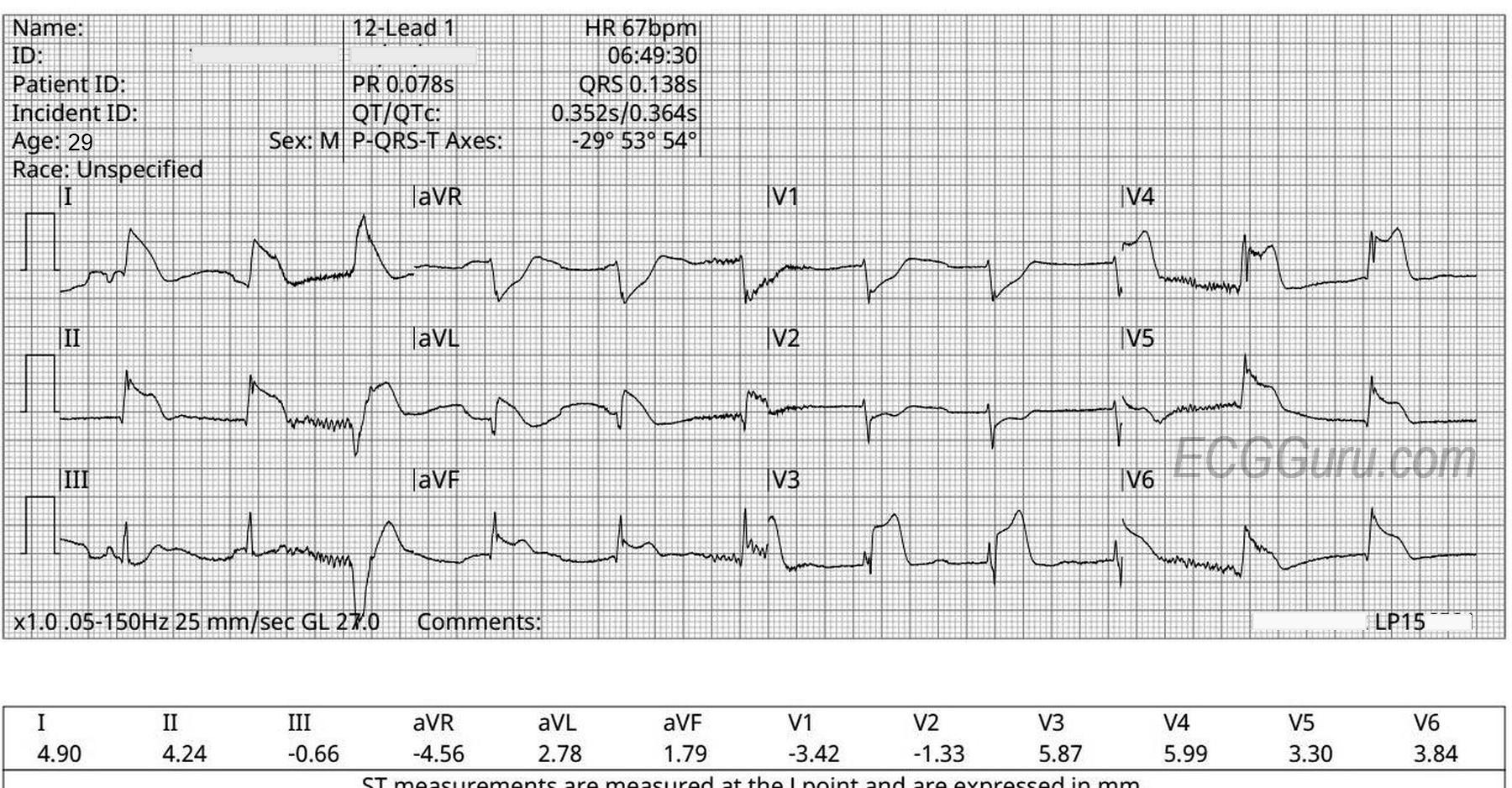 Accelerated junctional rhythm | ECG Guru - Instructor Resources
